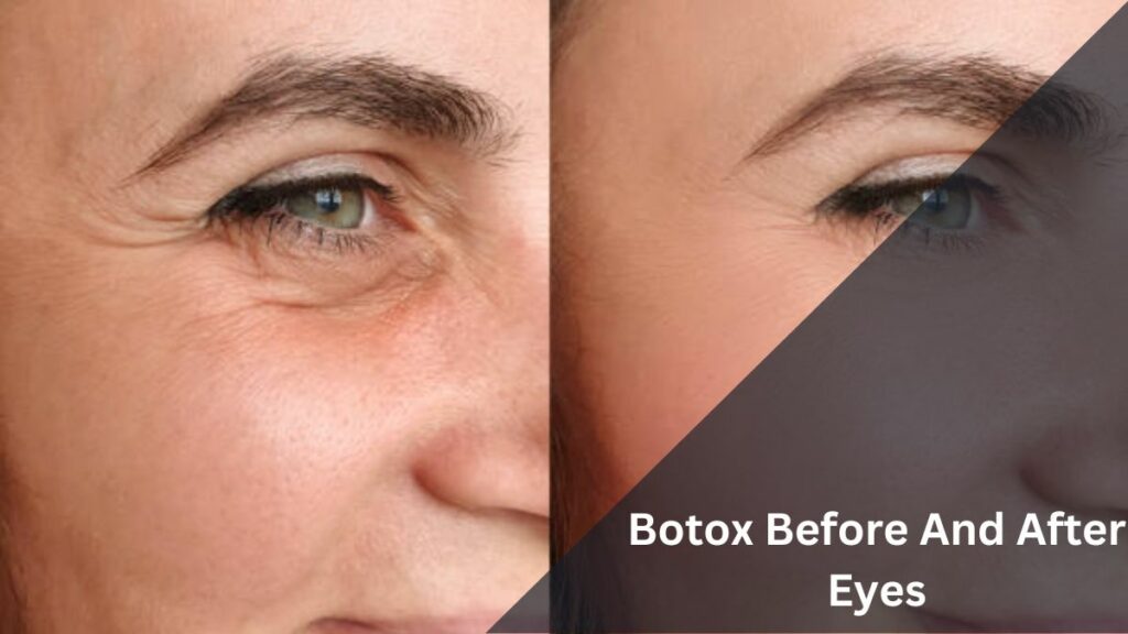 Botox Before And After Eyes