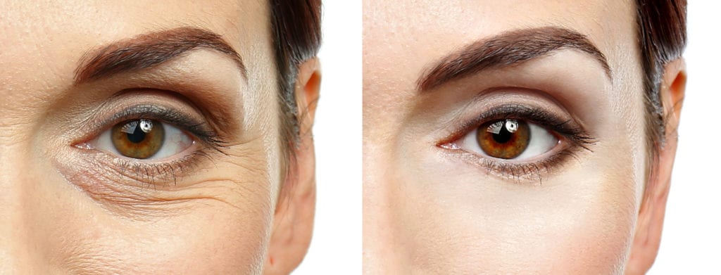 Comparing Botox Before And After